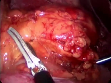 Right Minimally Invasive Adrenal Gland Removal With EnSeal Technique 