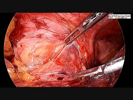 TAPP Hernia Repair by Ipsilateral Port