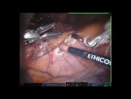 Mediastinal Tumor Robotic Resection with Lateral and Sub-Xiphoid Approach