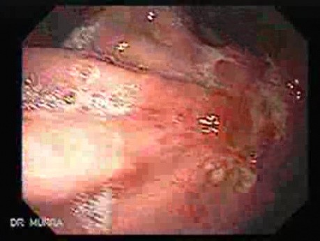 Adenocarcinoma of the Lesser Curvature with Signet Ring Cells (1 of 3) 2