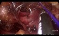 Vena Cava Repair During Retroperitoneoscopic Partial Nephrectomy