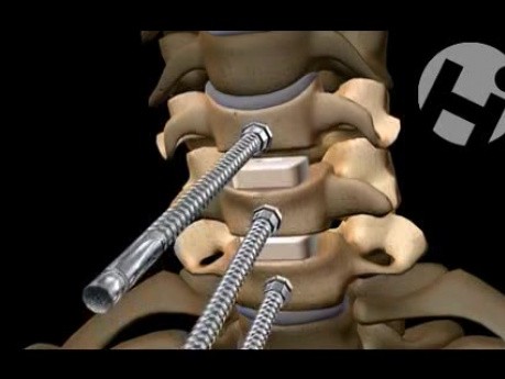 Anterior Cervical Corpectomy and Spinal Instrumentation