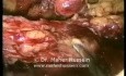 Right colon resection - Laparoscopy