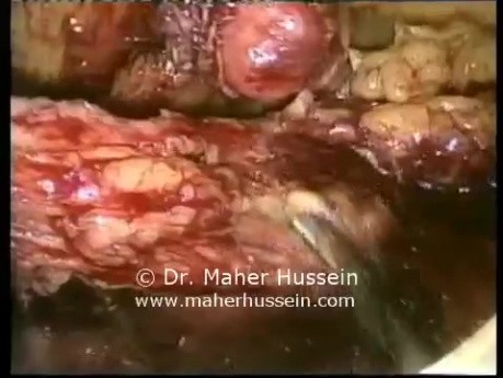 Right colon resection - Laparoscopy