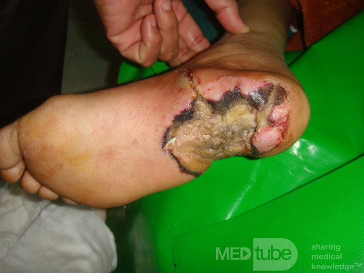 Diabetic foot - infected heel ulcer