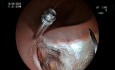 Perforation Closure - The Art of Clipping