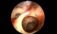 Functional Endoscopic Sinus Surgery (FESS)- 10Th Day post operative