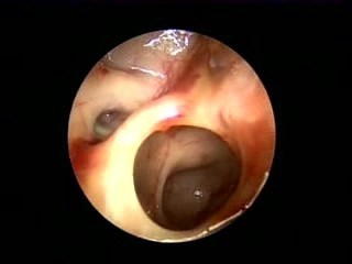Functional Endoscopic Sinus Surgery (FESS)- 10Th Day post operative