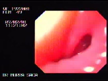 Esophageal Achalasia - Image of Narrowed Cardias