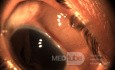 Blunt Trauma Dislocated Lens