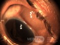 Blunt Trauma Dislocated Lens