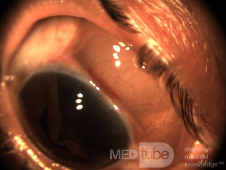 Blunt Trauma Dislocated Lens