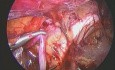 Laparoscopic Left Varicocelectomy