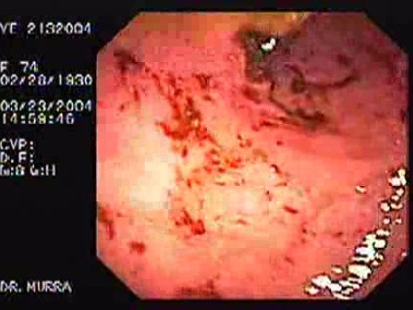 Variceal Hemorrhage - 74 Years-Old Female