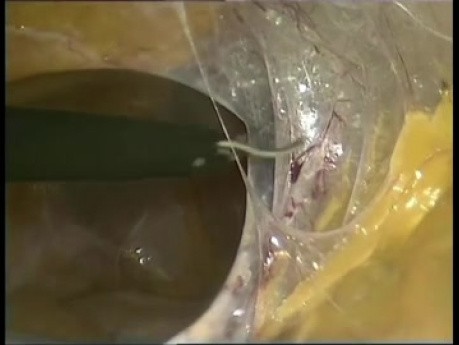Laparoscopic Adhesiolysis in a Patient with Severe Adherent Syndrome Following Multiple Interventions for Peritonitis 