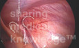 Laparoscopic Inguinal Anatomy