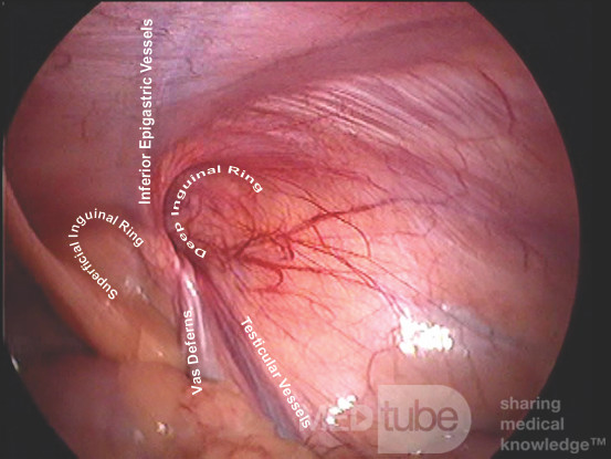 Laparoscopic Inguinal Anatomy