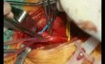 Carotid Endoarteriectomy