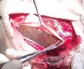 Acute Spontaneous Subdural Hemorrhage in the Subdural Space