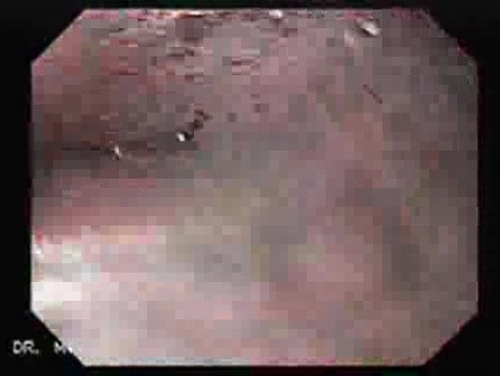 Esophageal Stricture After Total Gastrectomy And Chemoradiation - 62-Year Old Patient