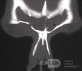 Right Frontal Sinus Fistula Post Trephination [CT scan]