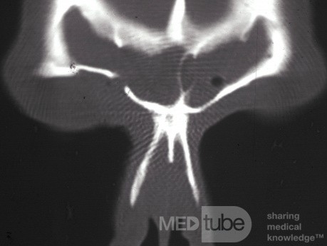 Right Frontal Sinus Fistula Post Trephination [CT scan]