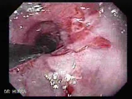 Endoscopic Baloon Dilation Of The Esophageal Stricture - Inflating The Baloon - Close-Up