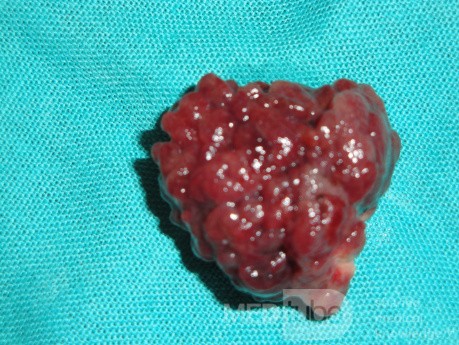Giant Multilobulated Gastric Polyp (19 of 20)