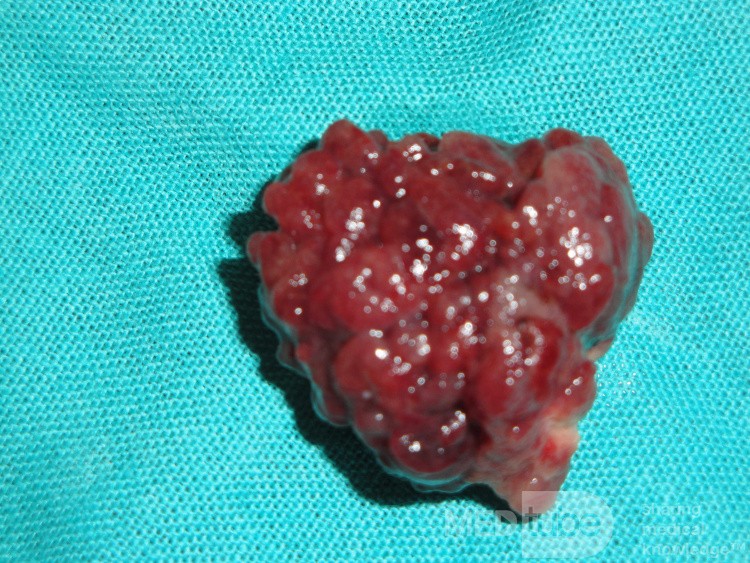 Giant Multilobulated Gastric Polyp (19 of 20)