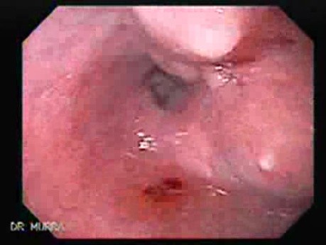 Esophageal Squamous Cell Carcinoma - Biopsy of the Lesion