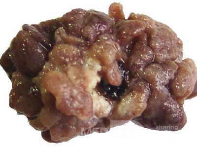 Distal Esophageal Squamous Cell Carcinoma (27 of 28)