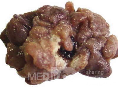 Distal Esophageal Squamous Cell Carcinoma (27 of 28)