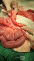 Incomplete Jejunoileal Junction Atresia Chronic Midgut Volvulus