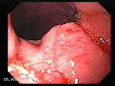 Adenocarcinoma of the Gastroesophageal Junction - Neoplastic Nodule