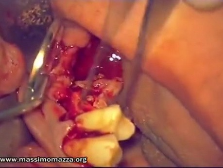 Immediate Implantation 14-18 (1/2)