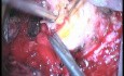 C1-C2 Schwannoma - Right Extradural Approach