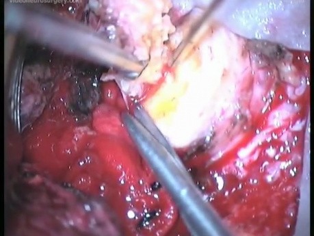 C1-C2 Schwannoma - Right Extradural Approach