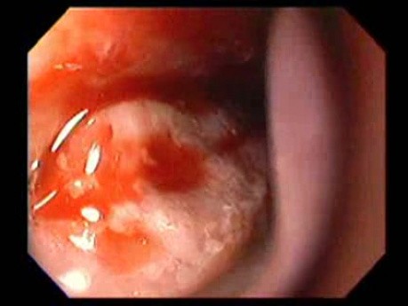 Massive Epistaxis - 76-year-old female patient - 7/8