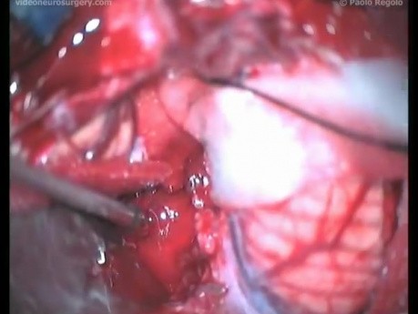 Medulloblastoma - Median Suboccipital Approach