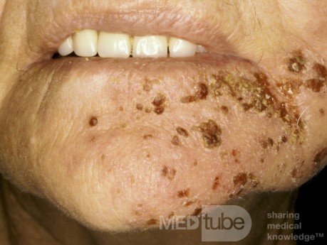 Herpes Zoster Chin Day 3