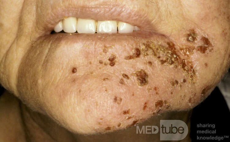 Herpes Zoster Chin Day 3
