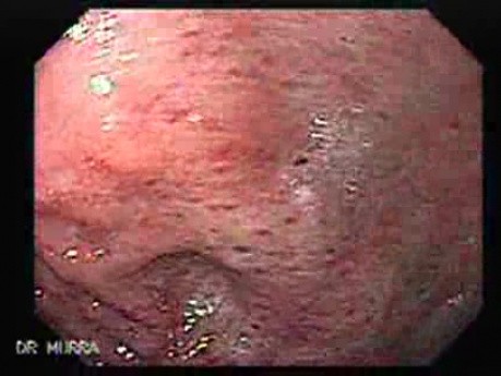 Gastric Lymphoma with Metastases to the Duodenum - Presence of the Food Residuals, Part 2