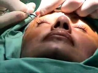 Eyebrow lift without incisions
