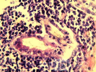 Gastroduodenal MALToma (11 of 12)