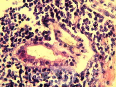 Gastroduodenal MALToma (11 of 12)