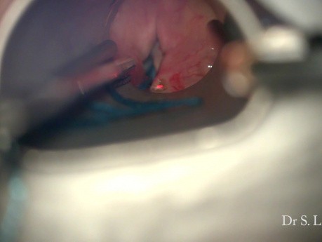 Bilateral Vocal Cord Paralysis Surgery
