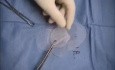 Inguinal hernia repair