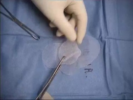 Inguinal hernia repair