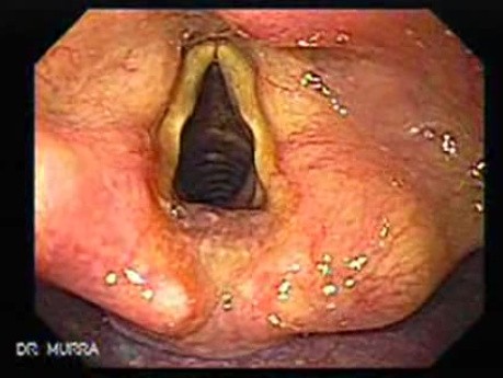 Klatskin´s Tumor - Yellowish of the Larynx