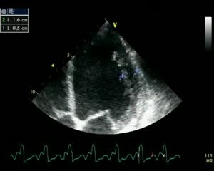 Left Ventriculi Non Compaction